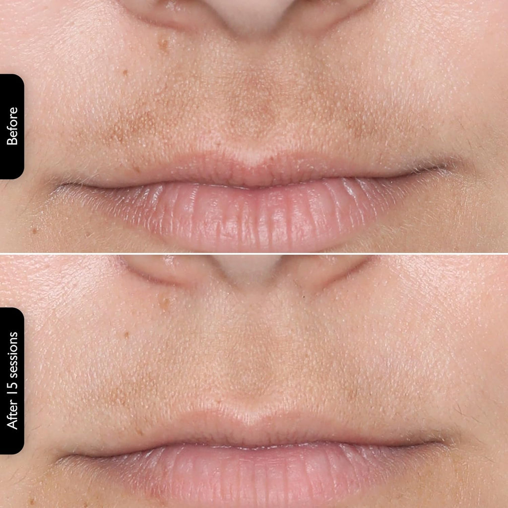 LEDMask | Amélioration de la peau avec la technologie LED